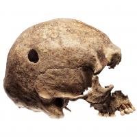 Trépanation pratiquée à l'Âge Viking sur le crâne d'un homme qui avait survécu à l'opération, tombe de Broa, Gotland - Photo: Musée historique de Stockholm