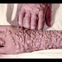 Virus de la variole après 10 jours - Photo: Mediscan